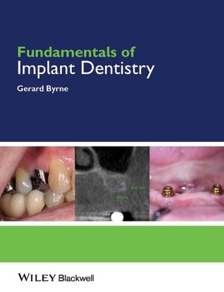 Read Online Fundamentals of Implant Dentistry (Fundamentals (Dentistry)) - Gerard Byrne | ePub