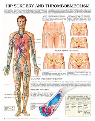 Download Hip surgery and thromboembolism e chart: Full illustrated - HC-HealthComm file in ePub